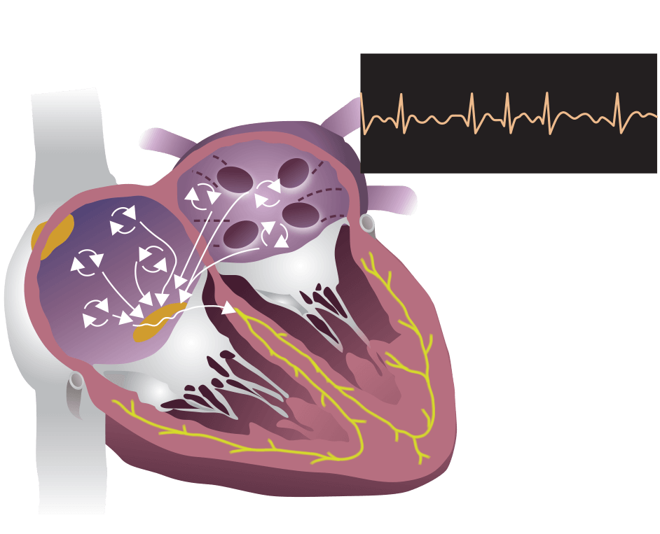 atrial fibrillation animation