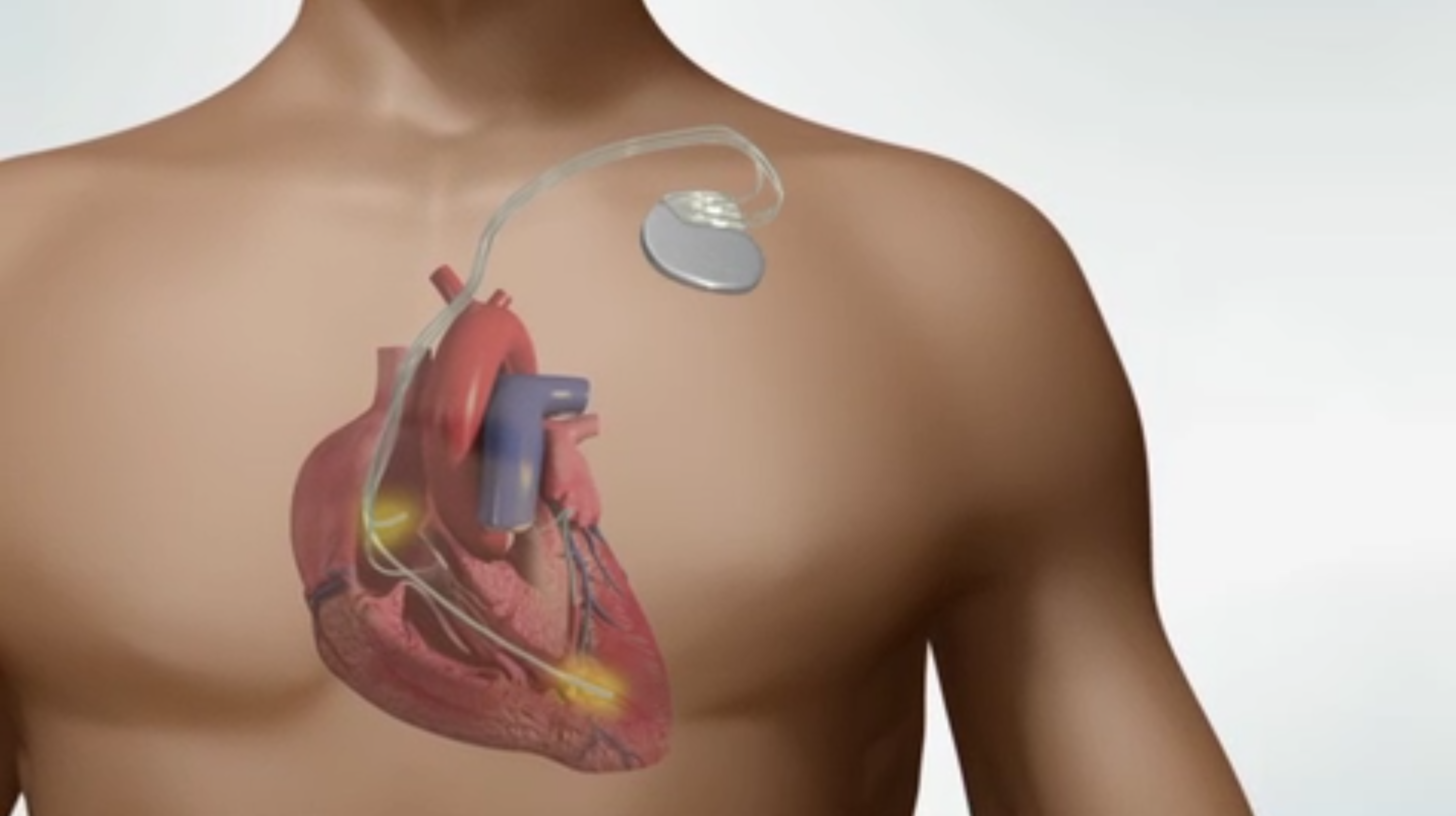 Pacemaker. Имплантация кардиовертера-дефибриллятора. Кардиостимулятор Pacemaker. Имплантируемый кардиовертер-дефибриллятор. Имплантация ИКД сердца что это.